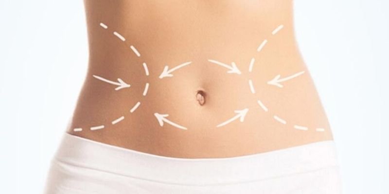 liposuction in India