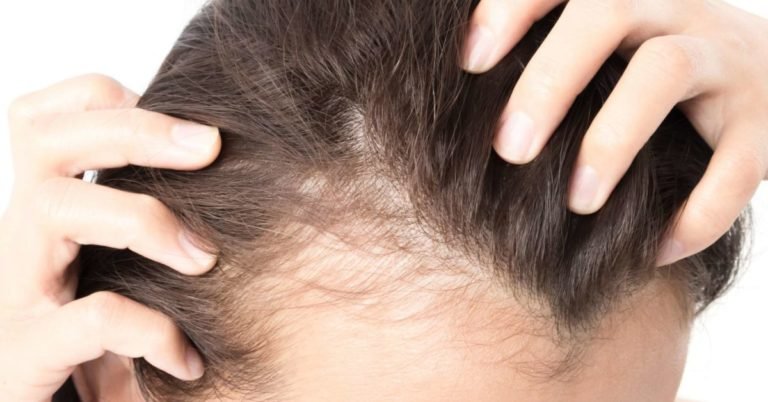 5 Hair Warning Signs Predicting Baldness