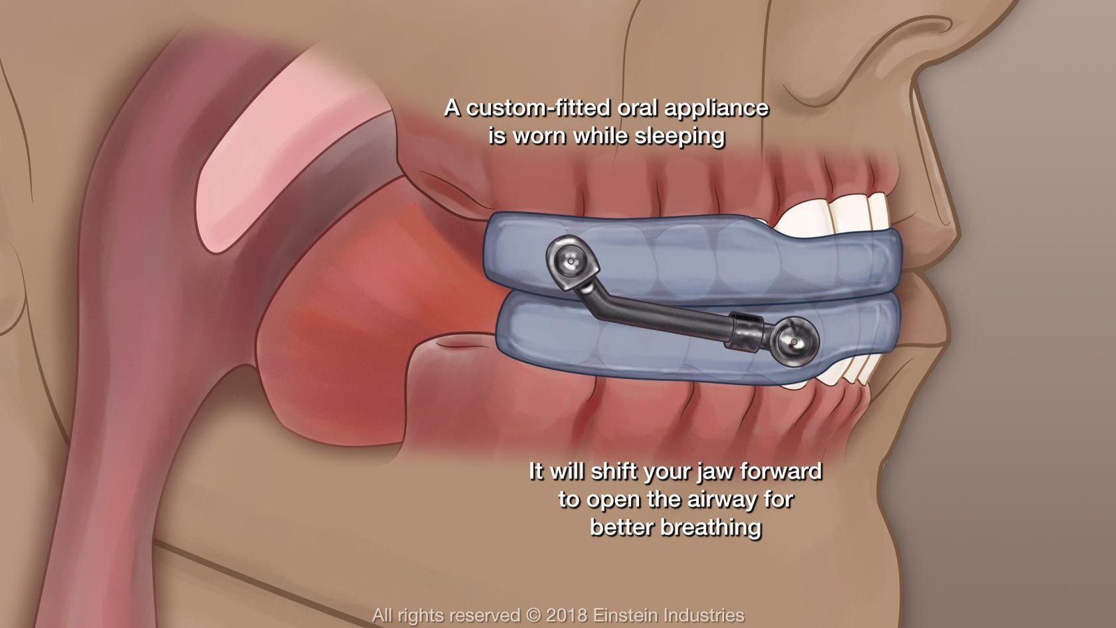 oral appliance sleep apnoea